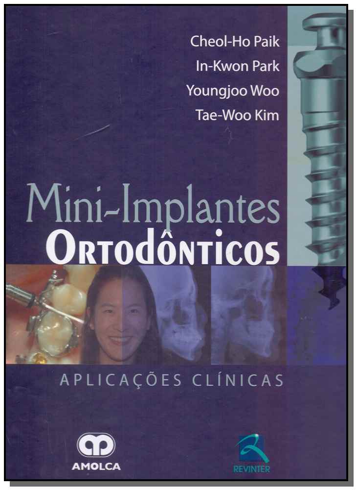 Mini-implantes Ortodônticos