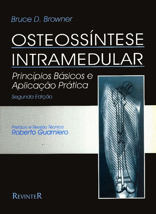 Osteossíntese Intramedular