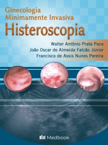 Histeroscopia - Ginecologia Minimamente Invasiva - 01Ed/21