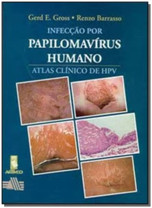 Infecção Por Papilomavírus Humano